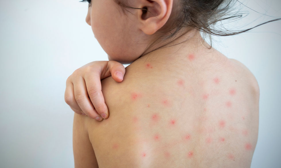 Sarampión sin cura médica: Secretaría de Salud urge a la vacunación para frenar contagios